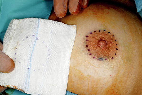 a reconstructed nipple with foam nipple guard in place.