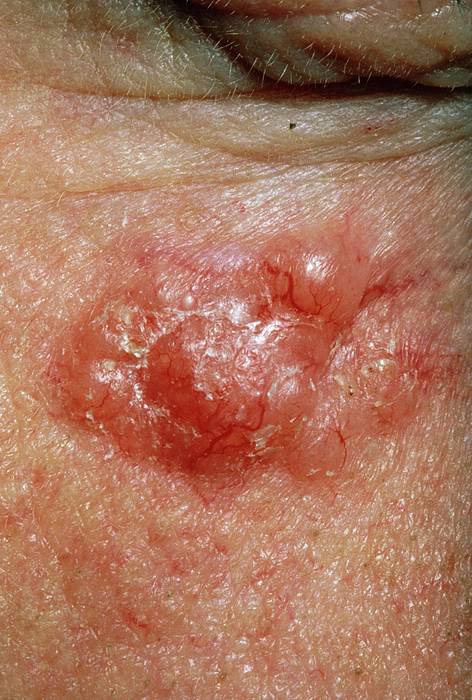 Basal Cell Carcinoma On A Patient's Cheek Greeting Card for Sale by ...