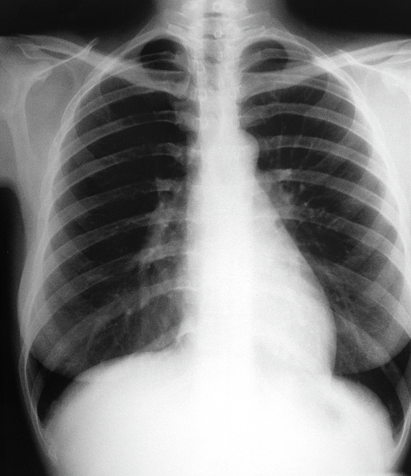 Chest X-ray Showing The Lungs Greeting Card by Science Photo Library.