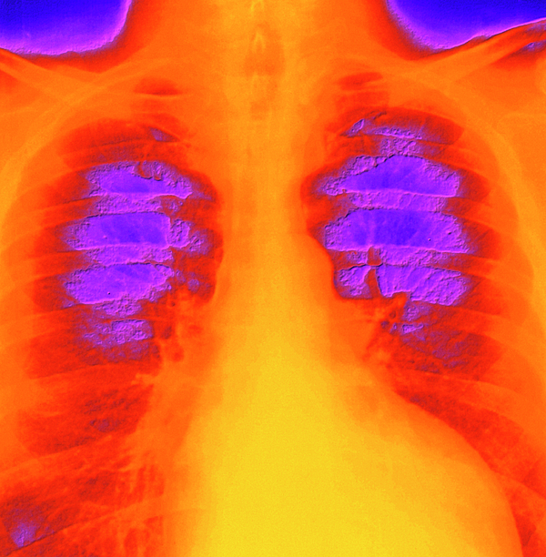 Coloured Chest X-ray Of Ventricular Cardiomyopathy Greeting Card by ...