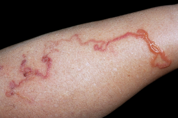 Cutaneous Larva Migrans Infection Greeting Card by Science Photo Library