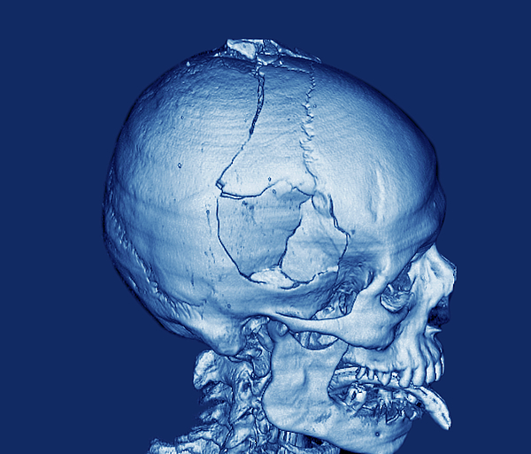 Fractured Skull Greeting Card for Sale by Zephyr/science Photo Library