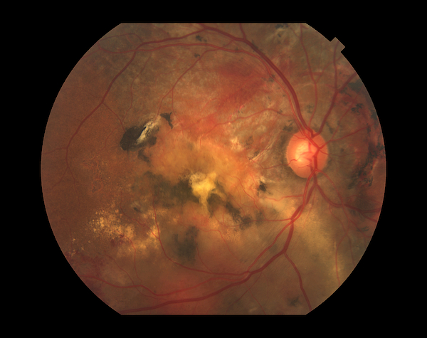Polypoidal Choroidal Vasculopathy Jigsaw Puzzle by Paul Whitten ...