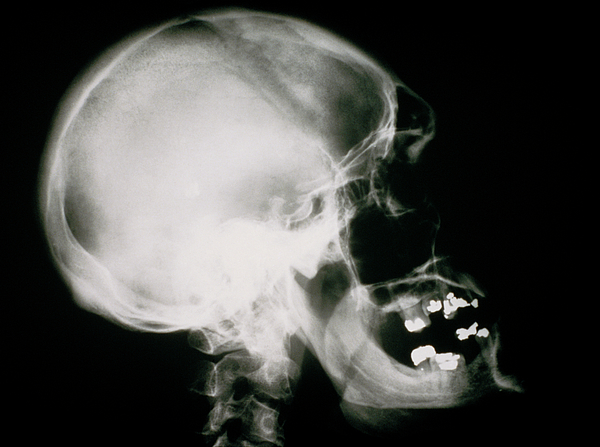 X-ray Of Human Skull Showing Acromegaly Greeting Card by Science Photo ...