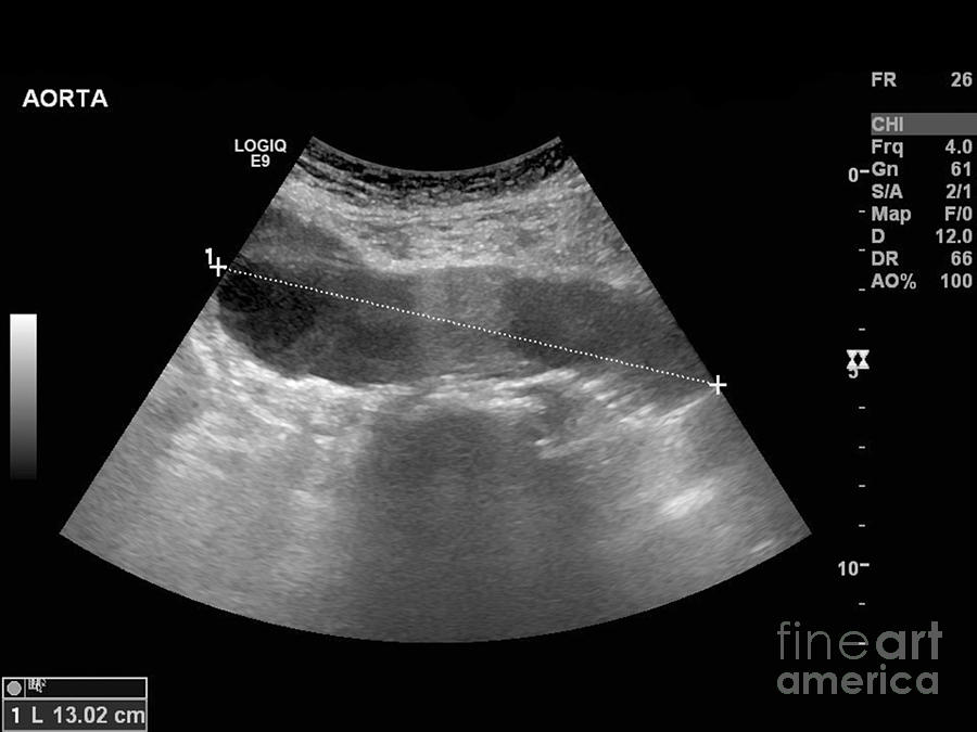 Abdominal Aorta Ultrasound