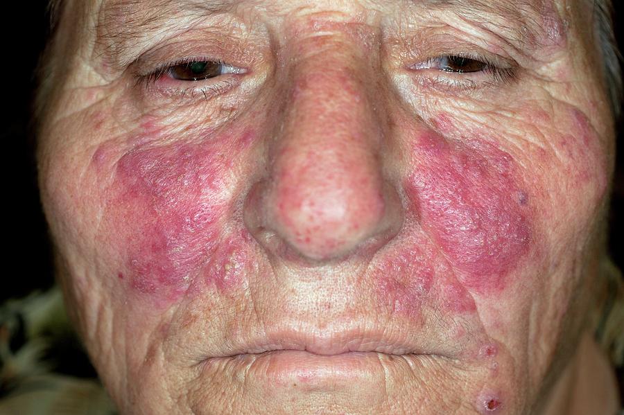 Acne Rosacea On The Face Photograph By Dr Harout Tanielianscience