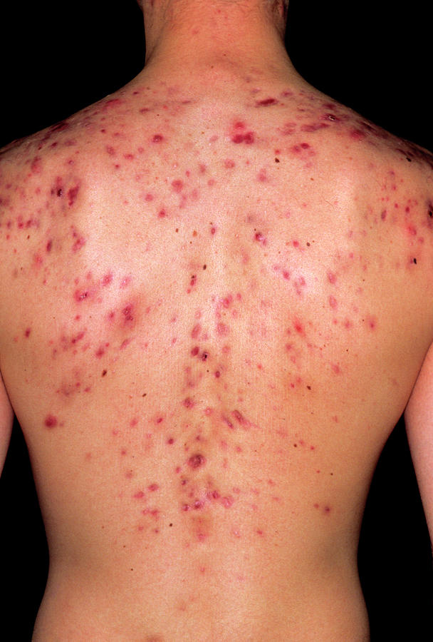 Acne Vulgaris On The Back Of A Young Man Photograph By Dr P Marazzi   1 Acne Vulgaris On The Back Of A Young Man Dr P Marazziscience Photo Library 