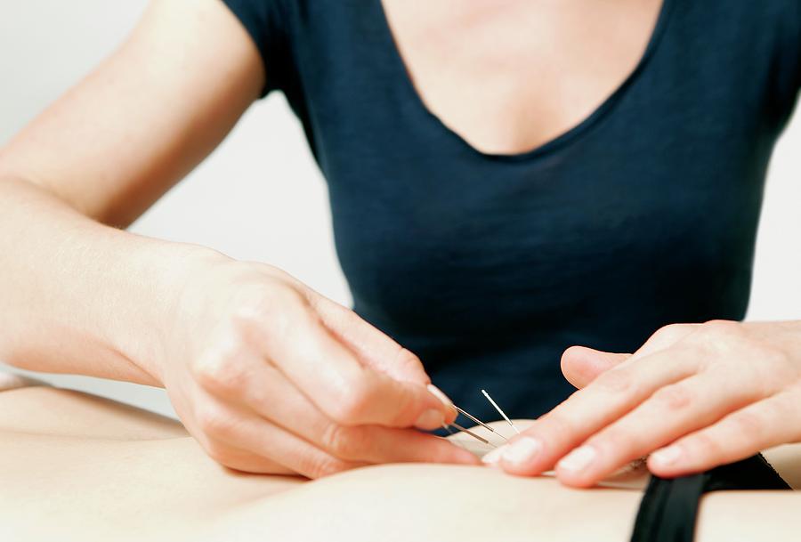Acupuncture Fertility Treatment Photograph by Thomas Fredberg Pixels