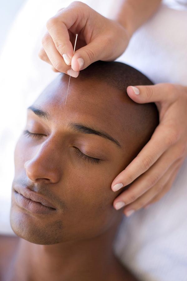 Acupuncture #1 Photograph by Ian Hooton/science Photo Library