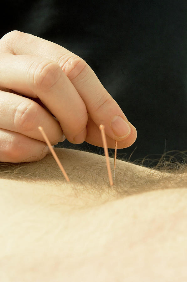 Acupuncture #1 Photograph by Mark Thomas/science Photo Library