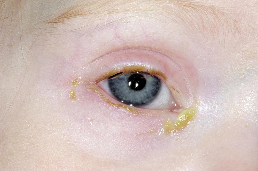 Acute Bacterial Conjunctivitis Photograph by Dr P. Marazzi/science