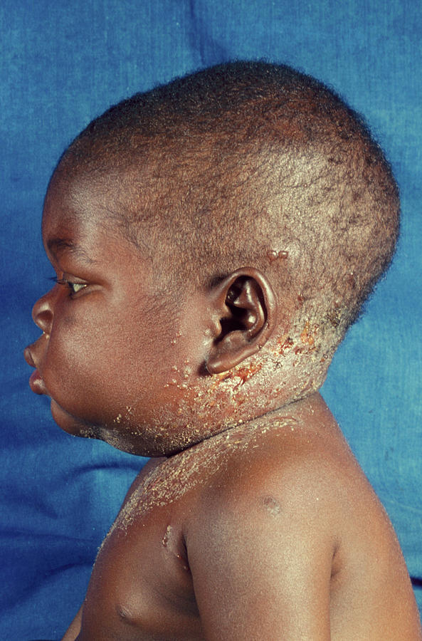 Aids Baby With Herpes 1 By Dr Ma Ansaryscience Photo Library