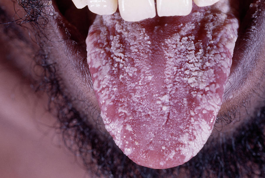 Aids Man With Candidiasis Photograph By Dr Ma Ansaryscience Photo