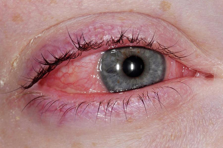 Allergic Conjunctivitis Of The Eye Photograph By Dr P Marazziscience