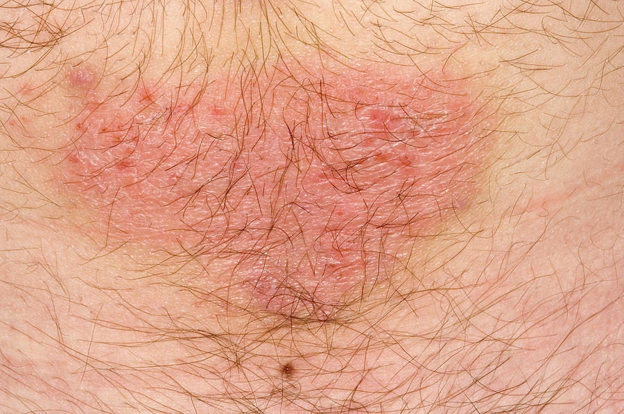 Allergic Contact Dermatitis Photograph By Dr P Marazzi Science Photo