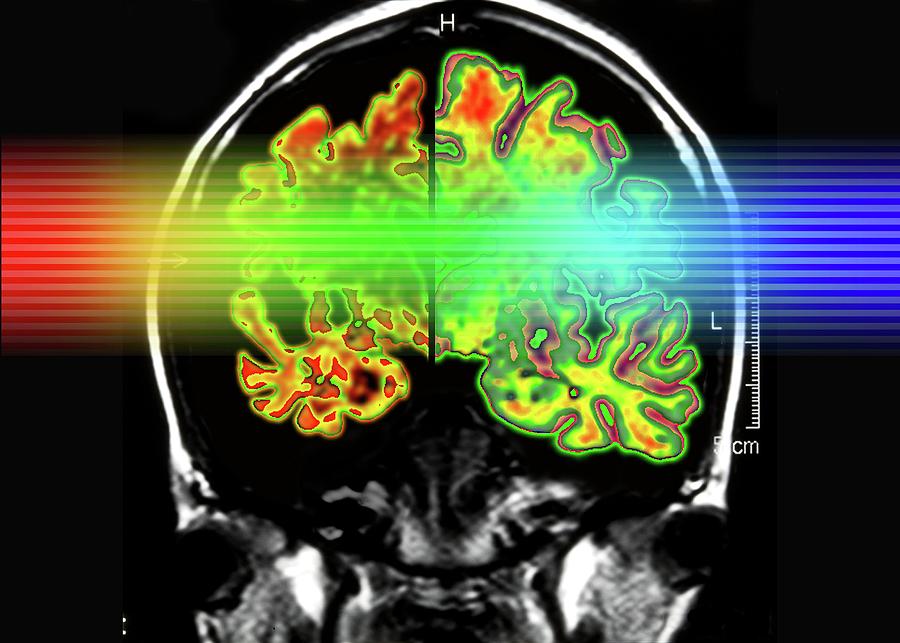 Alzheimers Brain #1 Photograph by Alfred Pasieka