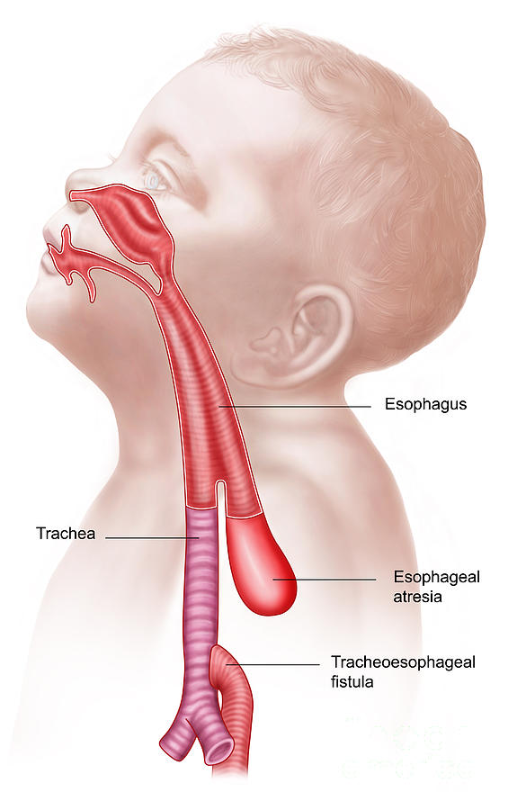 Esophagus Digital Art - Anatomy Of A Tracheoesophageal Fistula #1 by Stocktrek Images