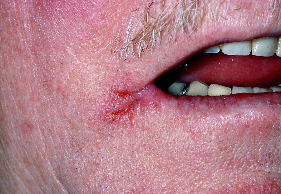 Angular Stomatitis Photograph by Dr P. Marazzi/science Photo Library