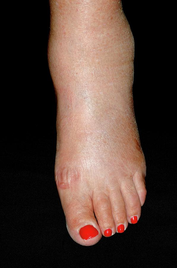 Ankle Swelling After Amlodipine Drug Photograph By Dr P Marazzi Science Photo Library