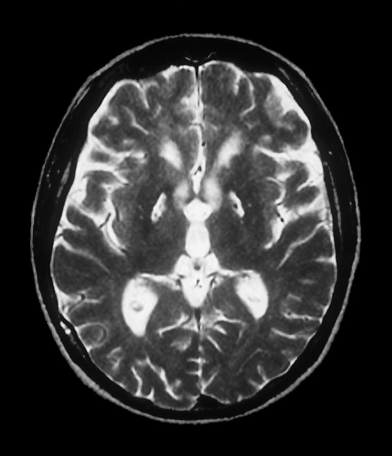 Anoxia Brain Damage Photograph By Zephyrscience Photo Library Pixels