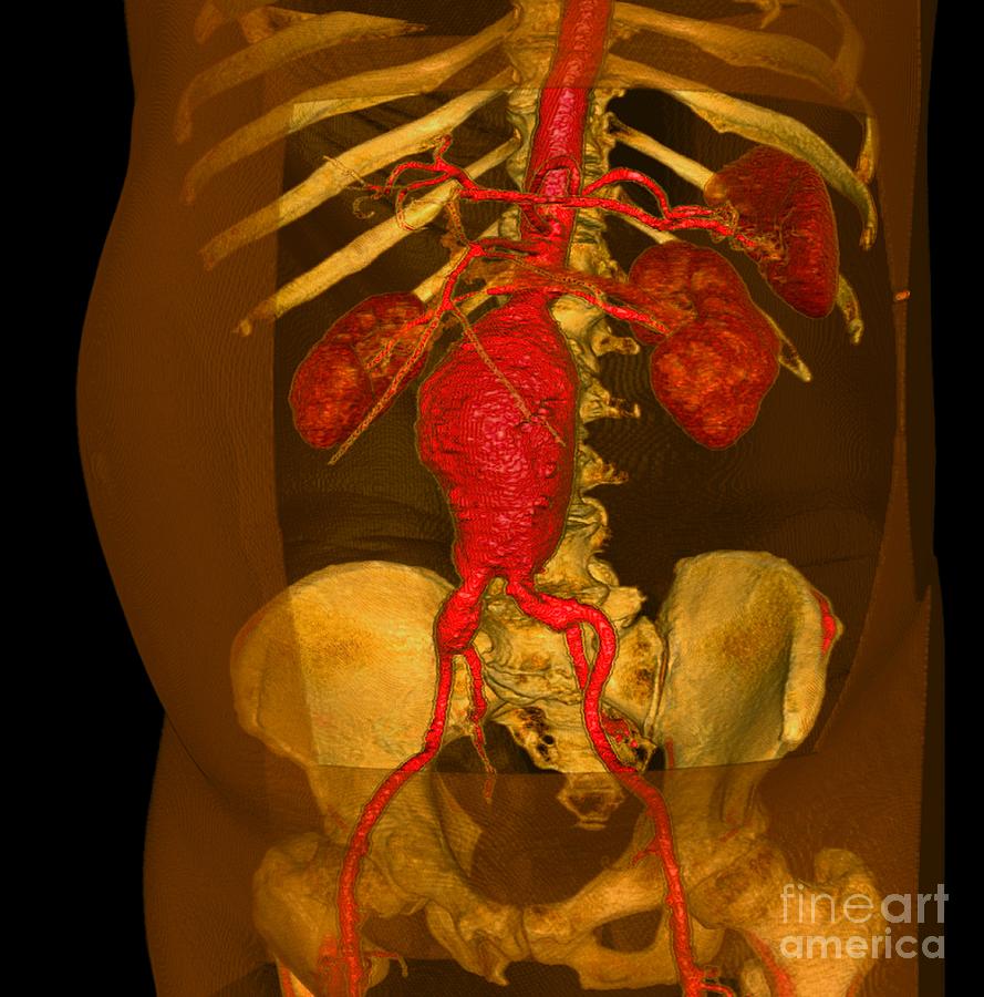 Aortic Aneurysm, 3-d Ct Scan Photograph by Du Cane Medical Imaging Ltd.