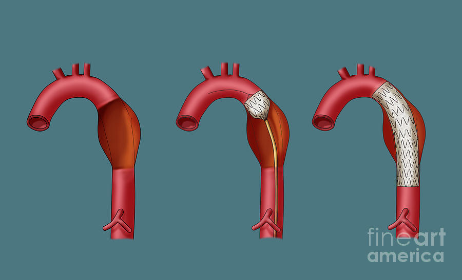 Aortic Aneurysm Stent, Illustration #1 Photograph by Monica Schroeder