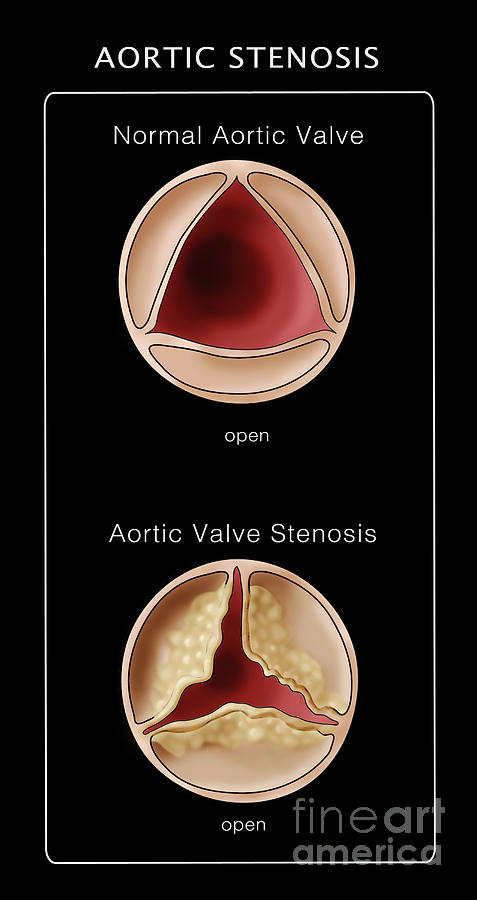 Aortic Valve, Normal & Stenosis #1 Photograph by Monica Schroeder