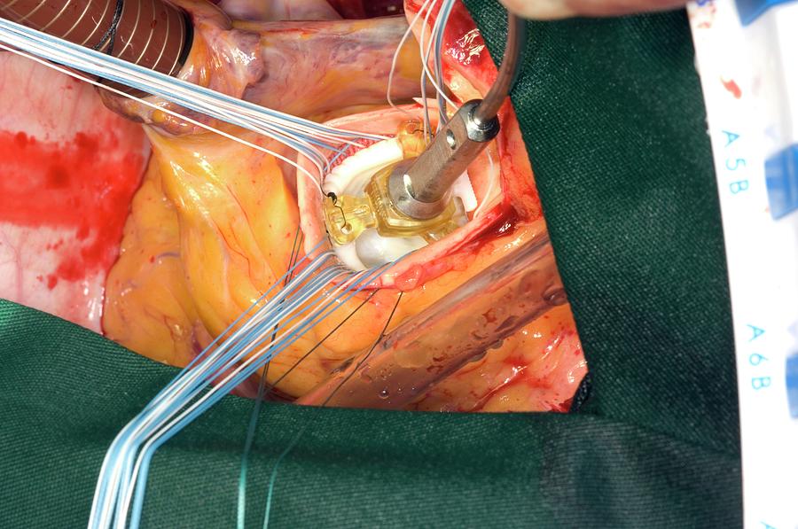 Aortic Valve Replacement Surgery Photograph by Dr P