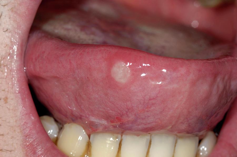 Open Ulcer On Tongue