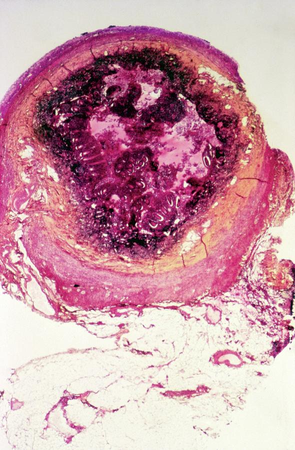 Medicine Photograph - Appendicitis #1 by Cnri/science Photo Library