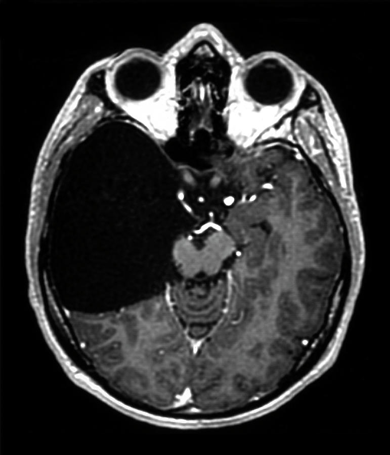 Brain Photograph - Arachnoid Cyst #1 by Zephyr/science Photo Library