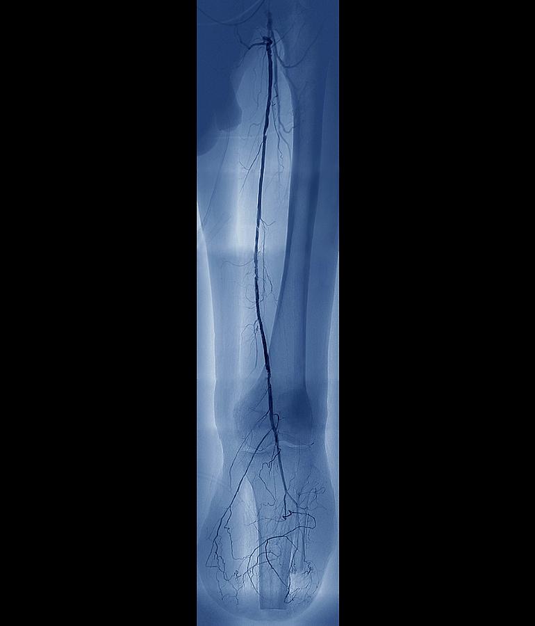 Arteritis Of The Leg #1 Photograph by Zephyr/science Photo Library