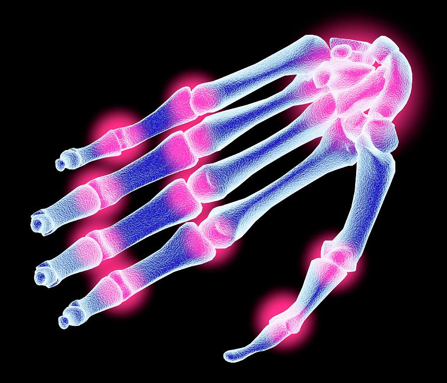 Arthritic Hand Bones Photograph by Alfred Pasieka/science Photo Library