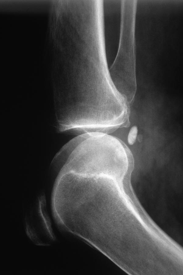 Arthritic Knee, X-ray #1 Photograph by Chris Bjornberg