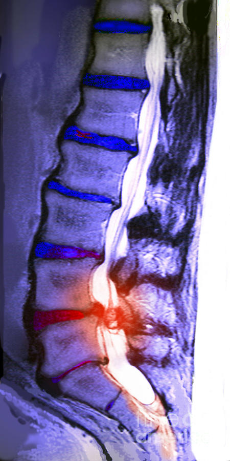 Arthritic Spine #1 Photograph by Chris Bjornberg
