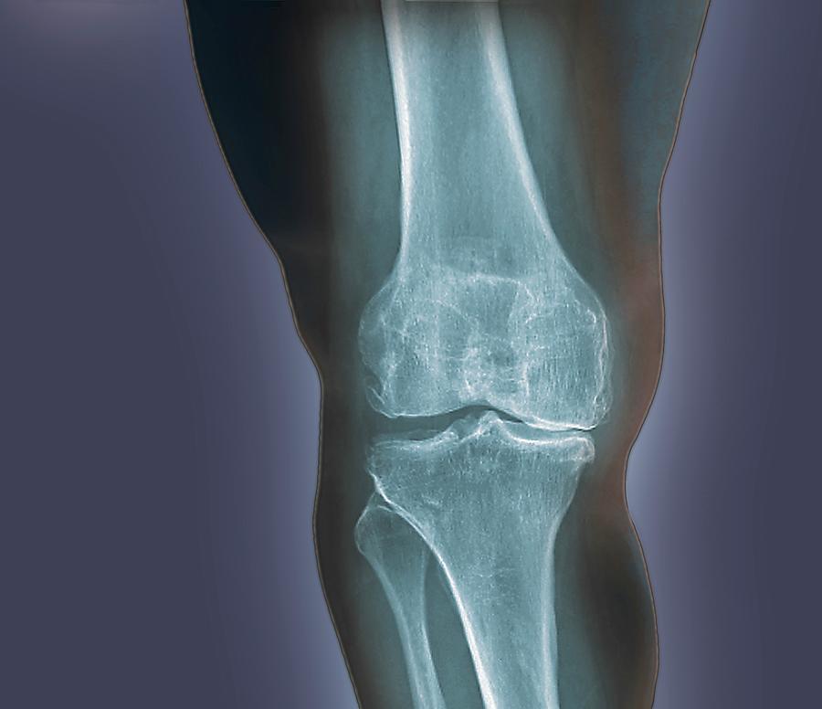 Xray Photograph - Arthritis Of The Knee #1 by Zephyr/science Photo Library
