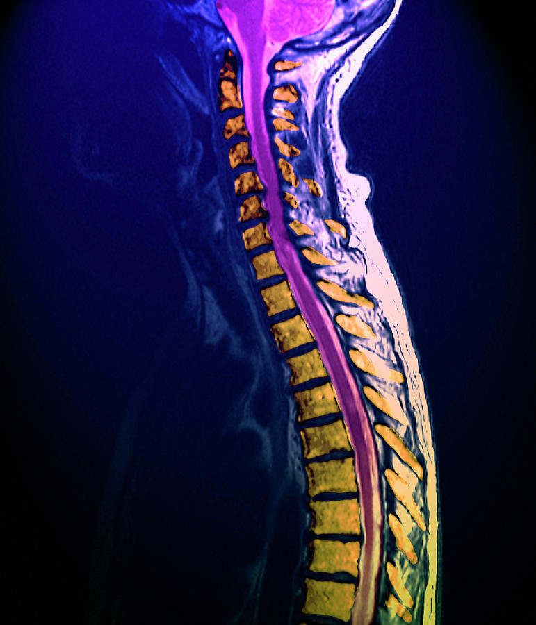 Arthritis Of The Spine Photograph by Zephyr/science Photo Library ...