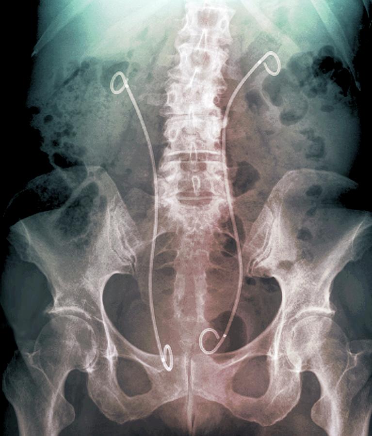 Рентген мочеточника. Стент в мочеточнике рентген. Камень в мочеточнике стент. Мочеточниковый катетер и стент рентген.