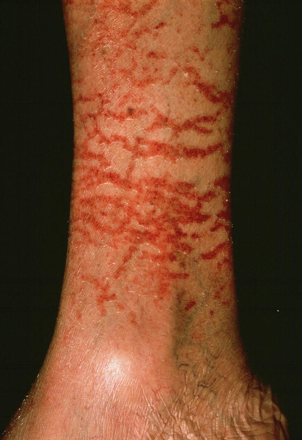 Asteatotic Eczema Photograph by Cnri/science Photo Library - Pixels