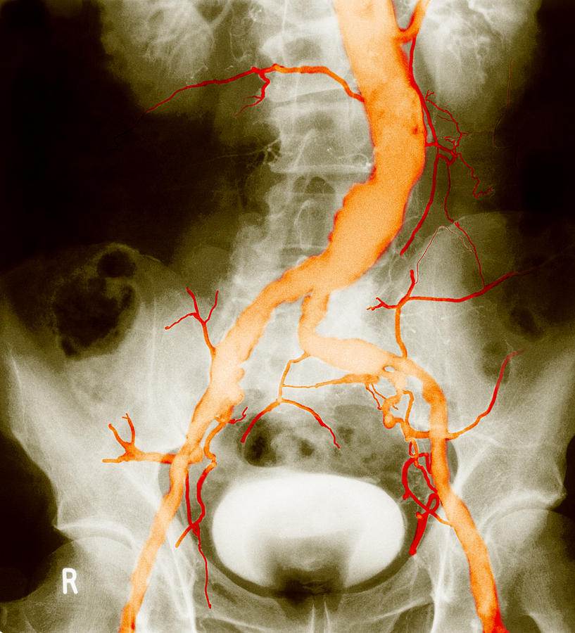 Atheroma In Aorta And Iliac Arteries #1 Photograph by John Watney