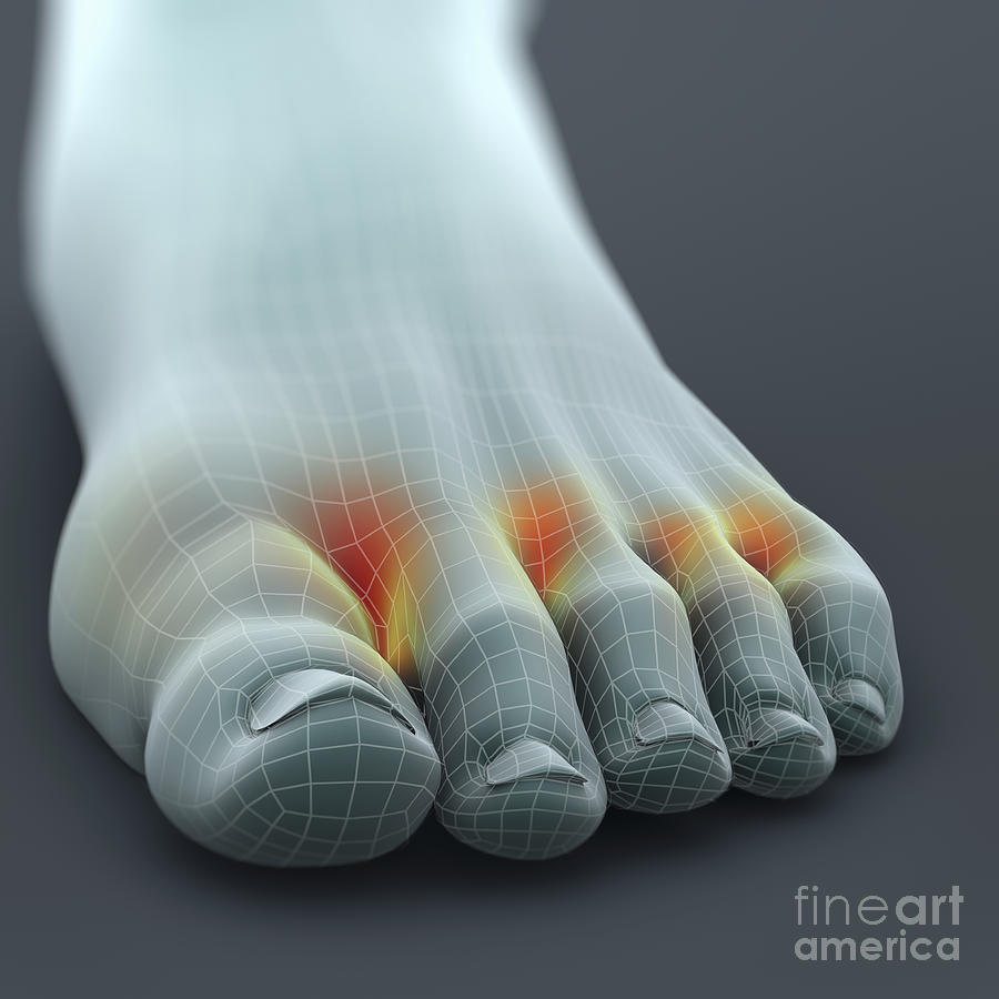 Infection Photograph - Athletes Foot #1 by Science Picture Co