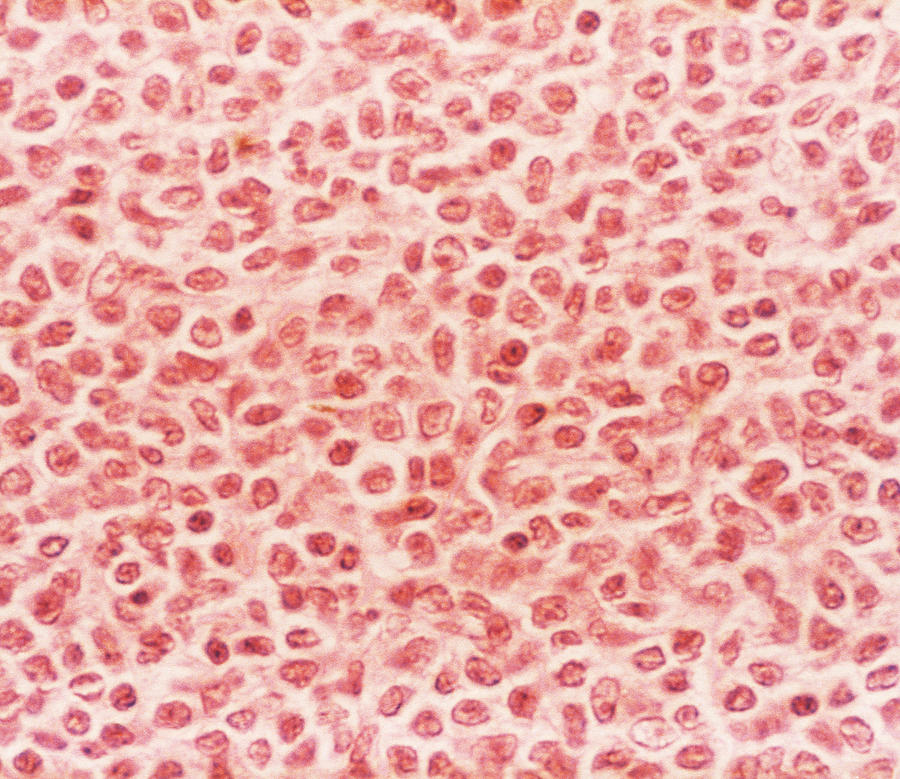 B-cell Lymphoma, Lm #1 Photograph by Biophoto Associates