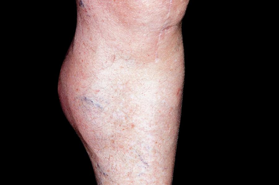 Baker S Cyst On The Leg Photograph By Dr P Marazzi Science Photo Library