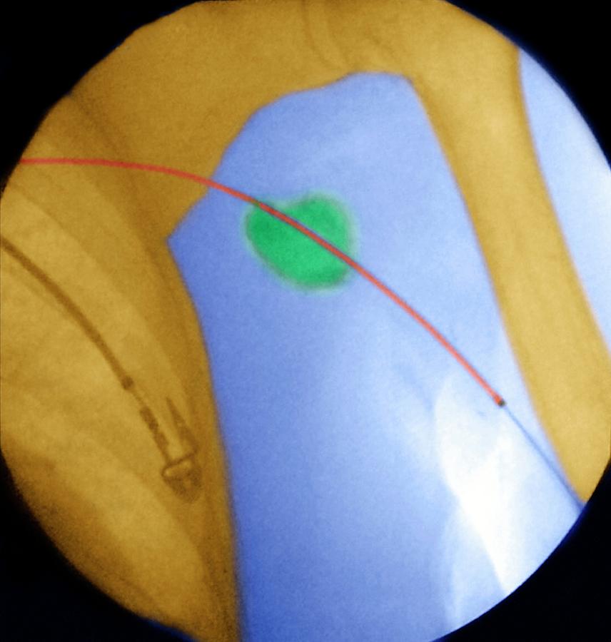 Blood Flow Photograph - Balloon Angioplasty by Aj Photo/science Photo Library Blood Flow Photograph - Balloon Angioplasty by Aj Photo/science Photo Library