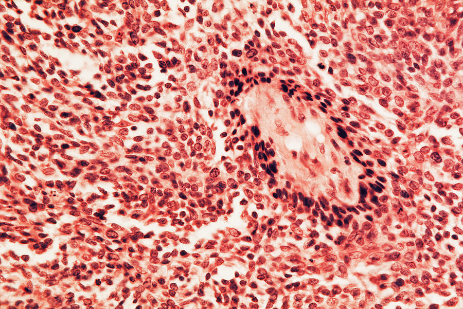 Basal Cell Carcinoma, Lm #1 Photograph by Michael Abbey
