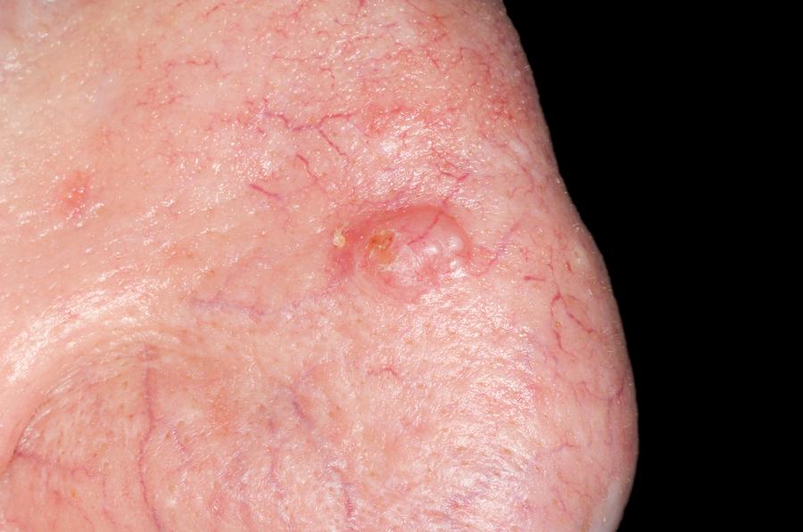 Basal Cell Carcinoma Of The Nose Photograph by Dr P. Marazzi/science ...