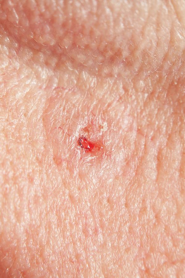 Rodent Ulcer Photograph - Basal Cell Carcinoma #1 by Saturn Stills/science Photo Library