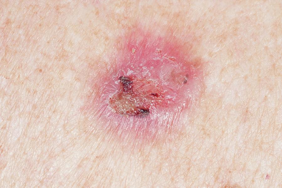 Pictures Of Skin Cancer On Back - the meta pictures