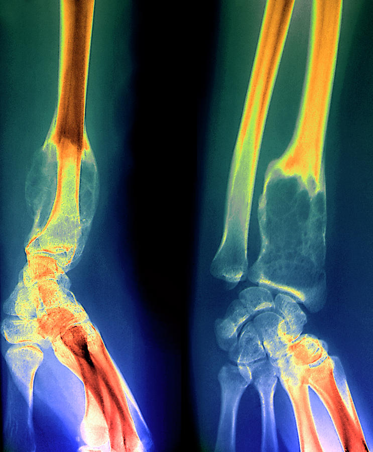 Benign Bone Tumour Photograph by Zephyr/science Photo Library - Fine ...