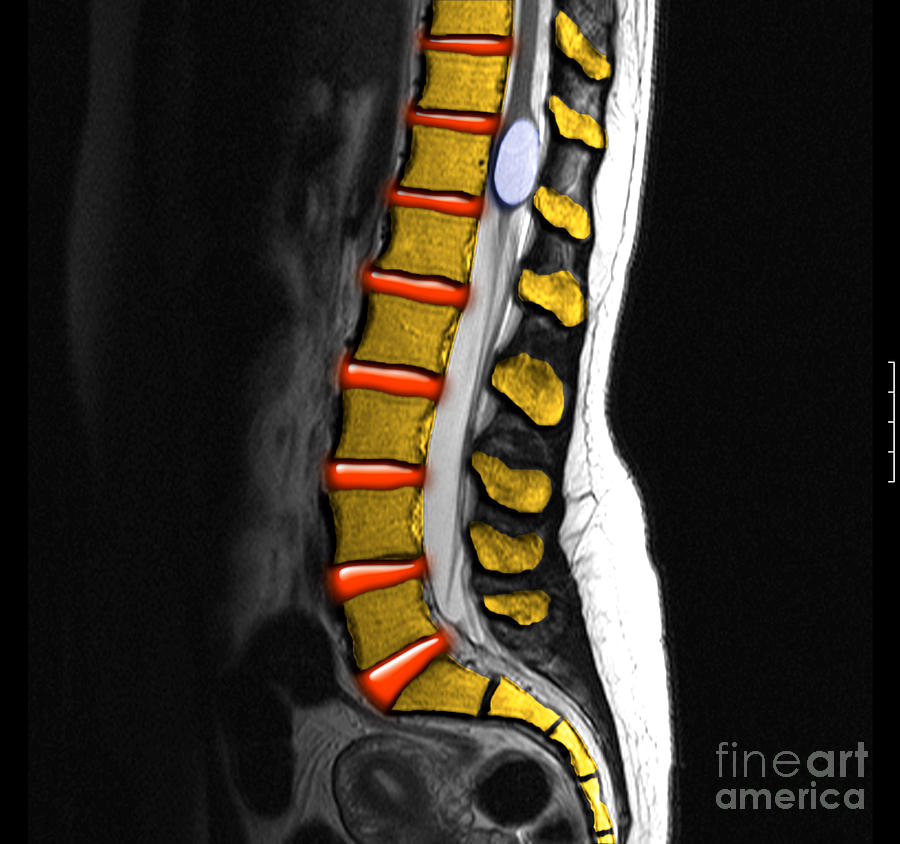 Benign Cyst In The Spine #1 Photograph by Living Art Enterprises, LLC
